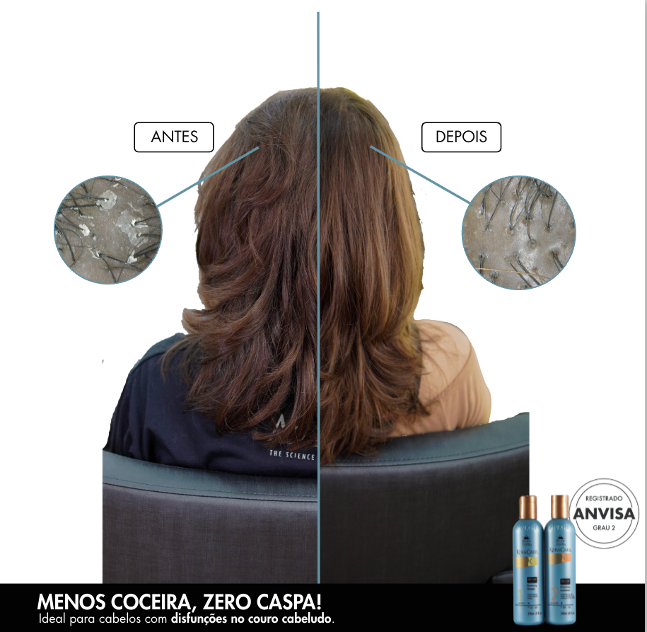 Resultado antes e depois da linha KeraCare Dry &amp; Itchy Scalp para couro cabeludo com coceira e caspa.