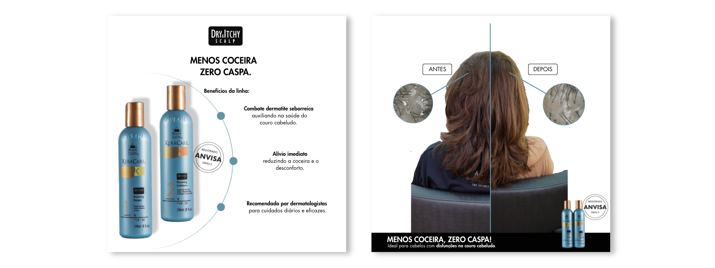 Painel de benefícios da linha KeraCare Dry & Itchy Scalp e comparação do couro cabeludo antes e depois.